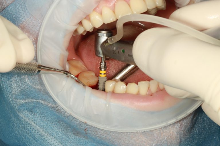 Dental Implants from experienced implant dentists in Sumter, SC.