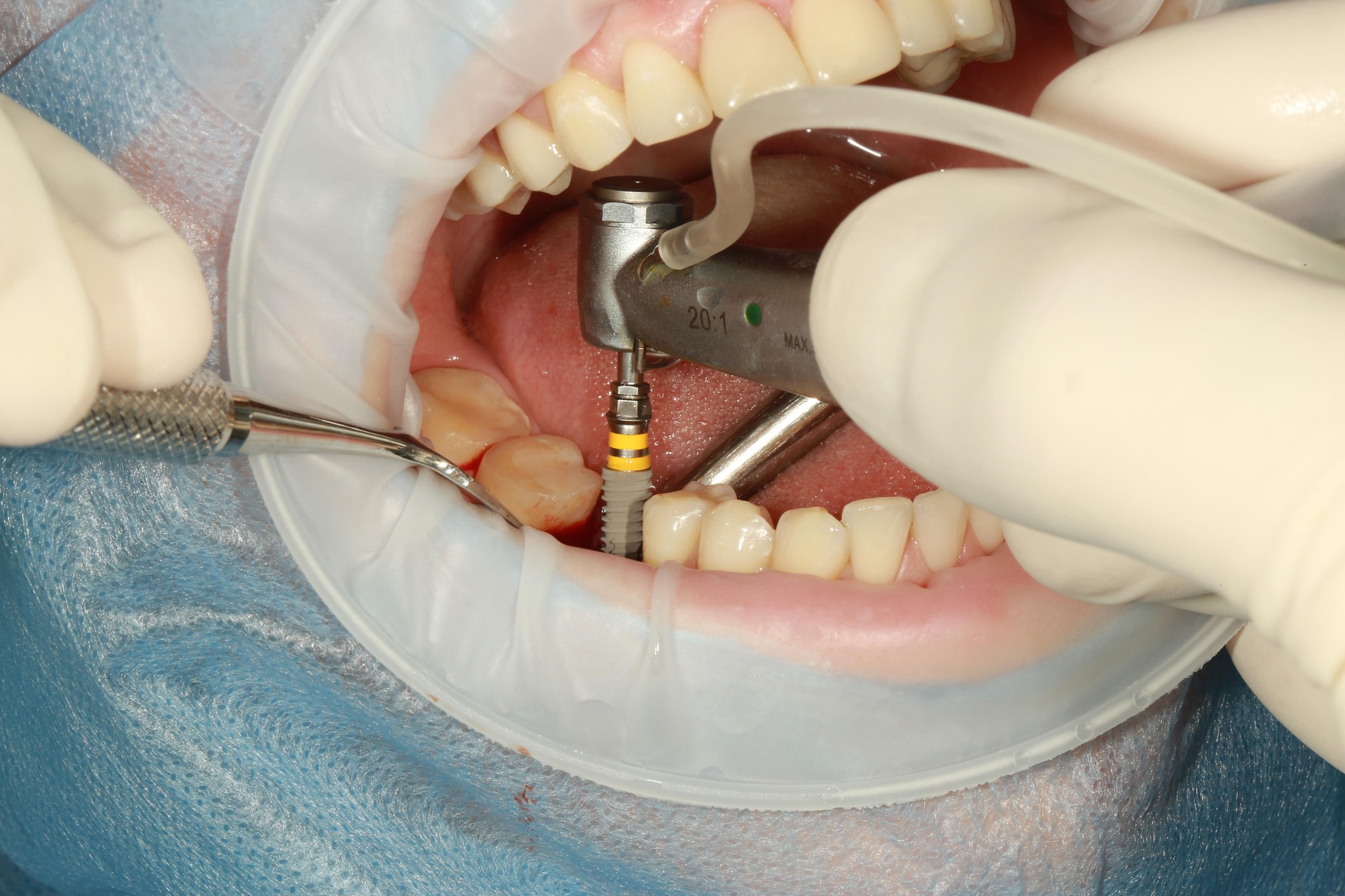 Dental Implants from experienced implant dentists in Sumter, SC.